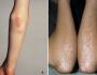 Сыпь на ногах фото с названием заболеваний Боль в суставах рук и ног сыпь
